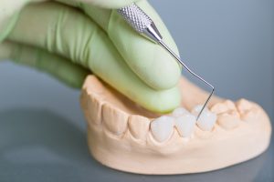 dental crown vs. dental bridge