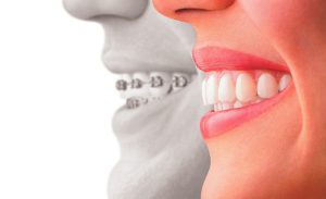 invisalign-vs-braces