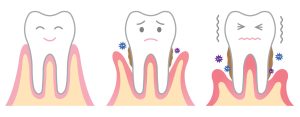 Periodontal Disease