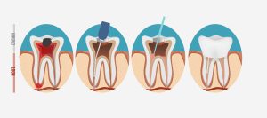 Root canal process